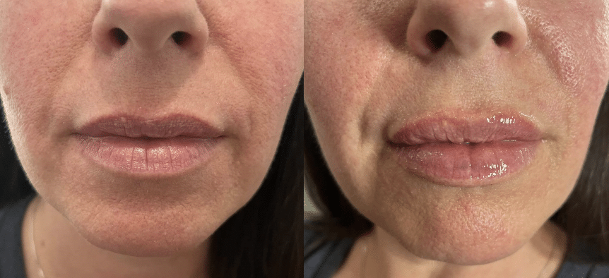 lip dermal fillers before and after Belton TX
