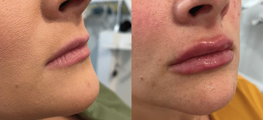 Dermal fillers and lip fillers