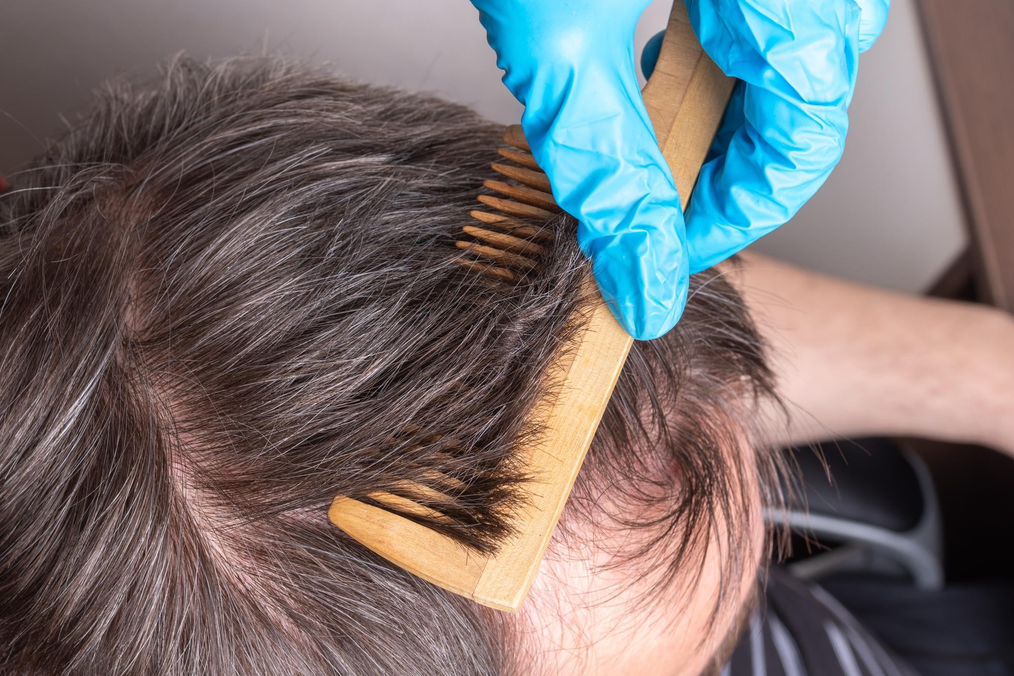 medical hair loss treatment for men and women